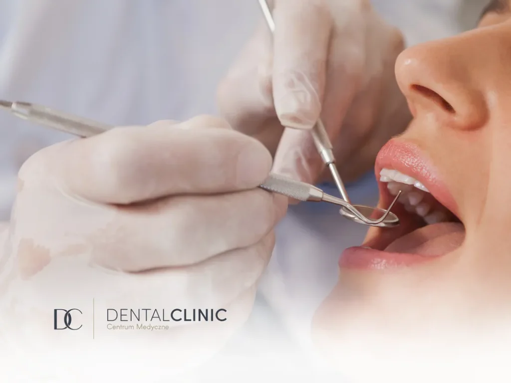 Kamień nazębny - czy jest niebezpieczny?