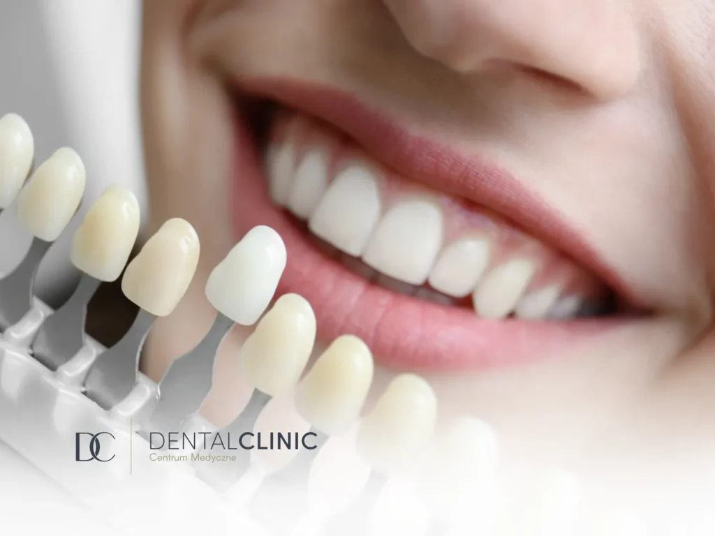 Co warto wiedzieć o licówkach przed zabiegiem?